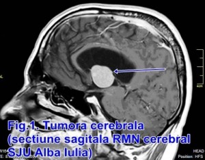 tumora cerebrala