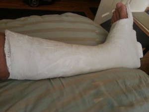 picior in gips